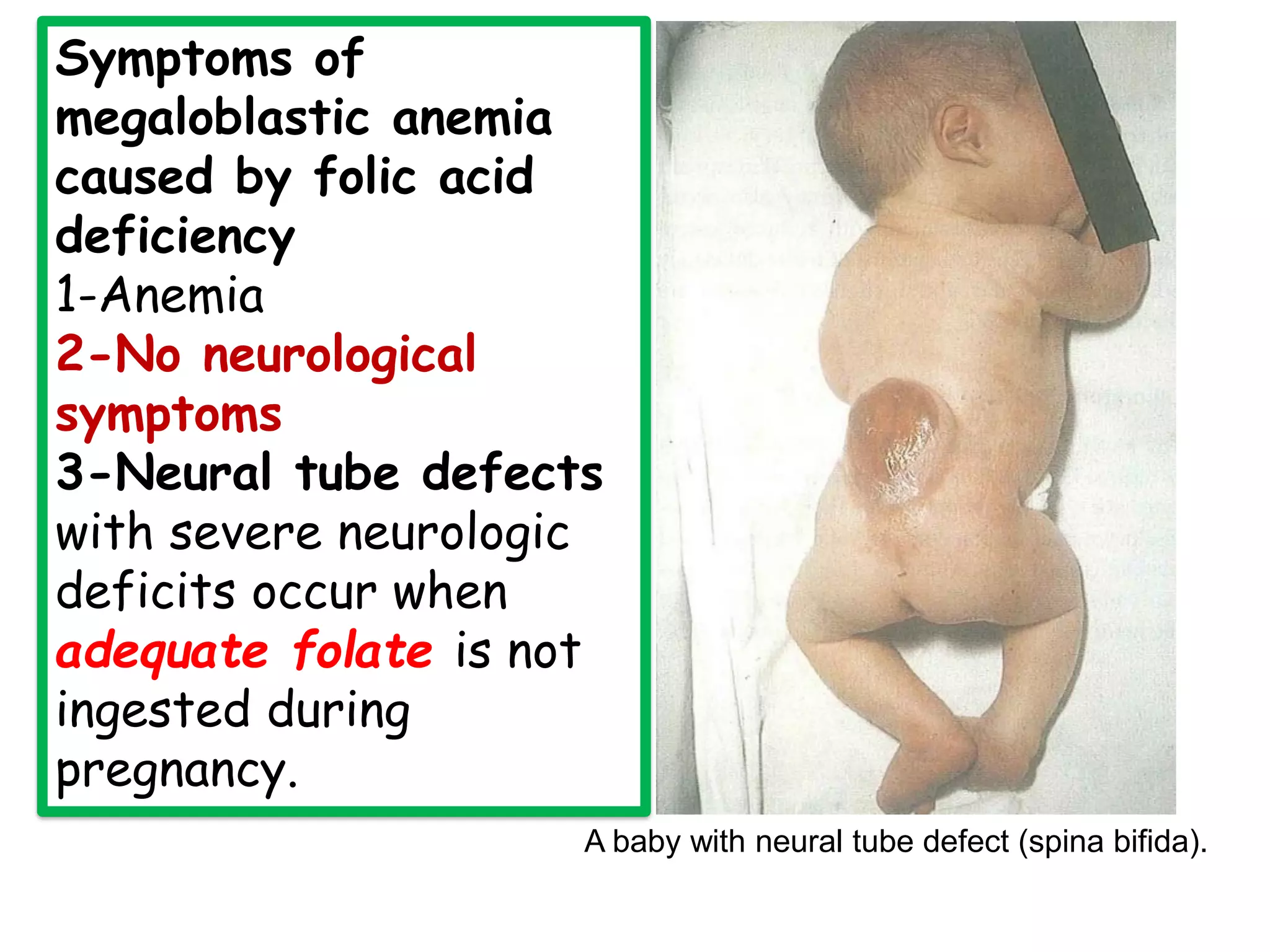 Symptoms of
megaloblastic anemia
caused by folic acid
deficiency
1-Anemia
2-No neurological
symptoms
3-Neural tube defects
with severe neurologic
deficits occur when
adequate folate is not
ingested during
pregnancy.
A baby with neural tube defect (spina bifida).
 