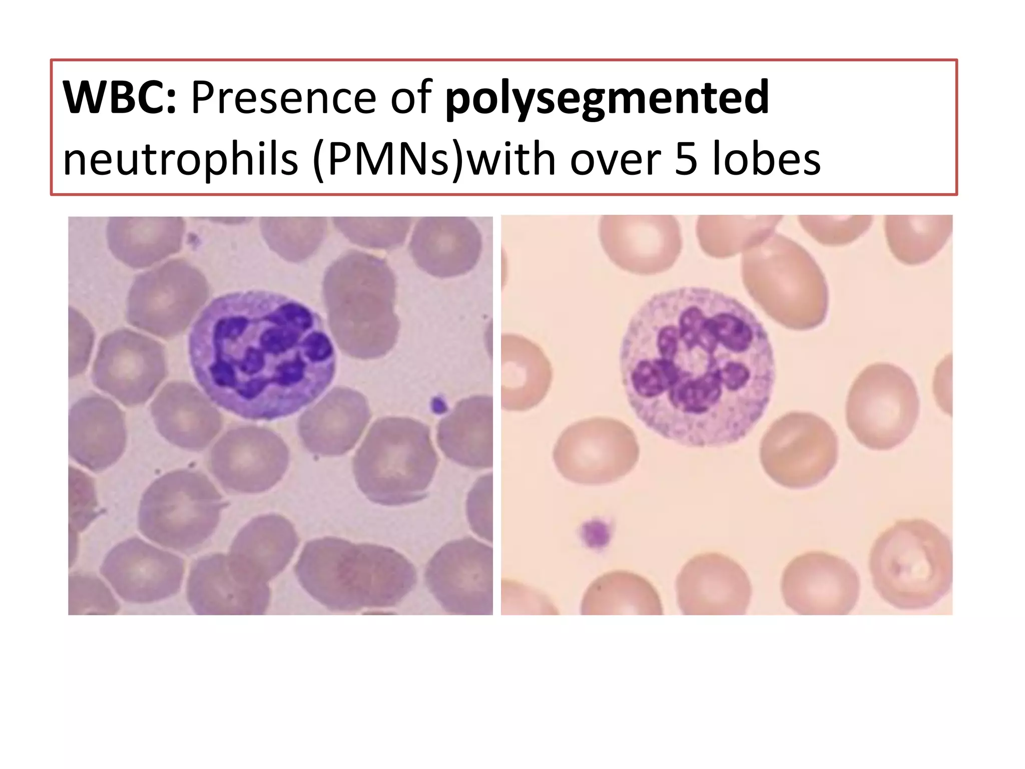 WBC: Presence of polysegmented
neutrophils (PMNs)with over 5 lobes
 