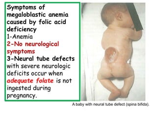 Symptoms of
megaloblastic anemia
caused by folic acid
deficiency
1-Anemia
2-No neurological
symptoms
3-Neural tube defects
with severe neurologic
deficits occur when
adequate folate is not
ingested during
pregnancy.
A baby with neural tube defect (spina bifida).
 