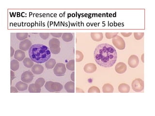 WBC: Presence of polysegmented
neutrophils (PMNs)with over 5 lobes
 