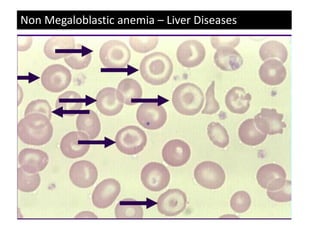 Non Megaloblastic anemia – Liver Diseases
 