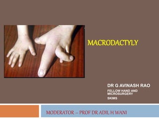 MODERATOR – PROF DR ADIL H WANI
DR G AVINASH RAO
FELLOW HAND AND
MICROSURGERY
SKIMS
MACRODACTYLY
 