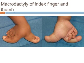 Macrodactyly of index finger and
thumb
 