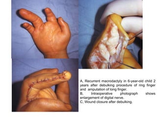 A, Recurrent macrodactyly in 6-year-old child 2
years after debulking procedure of ring finger
and amputation of long finger.
B, Intraoperative photograph shows
enlargement of digital nerve.
C, Wound closure after debulking.
 