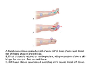 A, Matching sections (shaded areas) of volar half of distal phalanx and dorsal
half of middle phalanx are removed.
B, Distal phalanx is reduced on middle phalanx, with preservation of dorsal skin
bridge, but removal of excess soft tissue.
C, Soft-tissue closure is completed, accepting some excess dorsal soft tissue.
 
