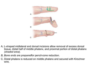 A, L-shaped midlateral and dorsal incisions allow removal of excess dorsal
tissue, distal half of middle phalanx, and proximal portion of distal phalanx
(shaded area).
B, Bone ends are preparedfor pencil-cone reduction.
C, Distal phalanx is reduced on middle phalanx and secured with Kirschner
wire.
 