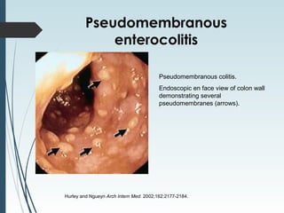 Pseudomembranous
enterocolitis
Hurley and Ngueyn Arch Intern Med. 2002;162:2177-2184.
Pseudomembranous colitis.
Endoscopic en face view of colon wall
demonstrating several
pseudomembranes (arrows).
 