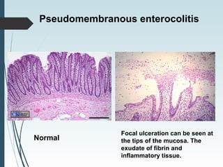 Focal ulceration can be seen at
the tips of the mucosa. The
exudate of fibrin and
inflammatory tissue.
Pseudomembranous enterocolitis
Normal
 