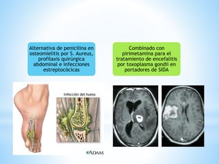 Alternativa de penicilina en
osteomielitis por S. Aureus,
profilaxis quirúrgica
abdominal e infecciones
estreptocócicas
Combinado con
pirimetamina para el
tratamiento de encefalitis
por toxoplasma gondii en
portadores de SIDA
 