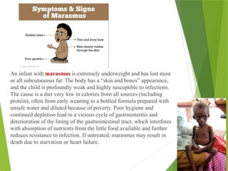 An infant with marasmus is extremely underweight and has lost most
or all subcutaneous fat. The body has a “skin and bones” appearance,
and the child is profoundly weak and highly susceptible to infections.
The cause is a diet very low in calories from all sources (including
protein), often from early weaning to a bottled formula prepared with
unsafe water and diluted because of poverty. Poor hygiene and
continued depletion lead to a vicious cycle of gastroenteritis and
deterioration of the lining of the gastrointestinal tract, which interferes
with absorption of nutrients from the little food available and further
reduces resistance to infection. If untreated, marasmus may result in
death due to starvation or heart failure.
 