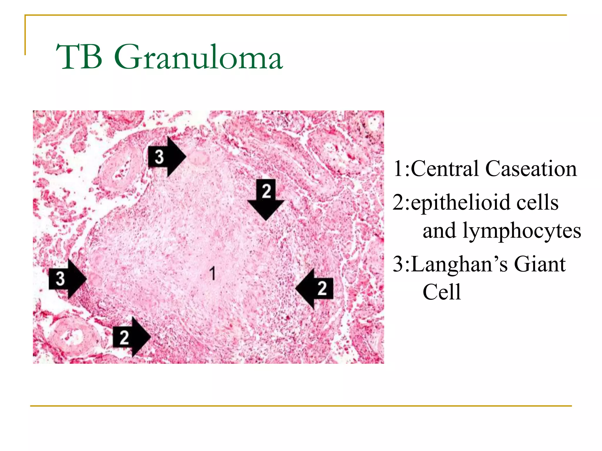 Caseating Definition Macrophage in Health and Disease.ppt