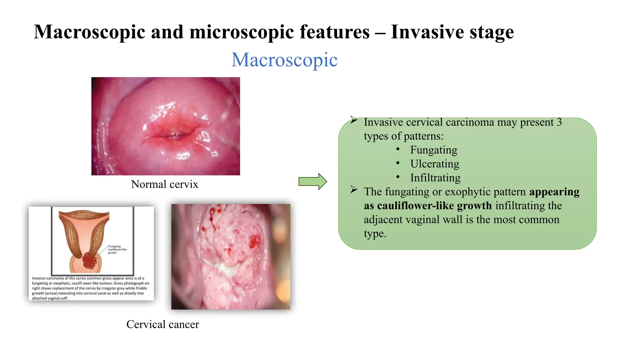 Macroscopic and microscopic features – Invasive stage
Macroscopic
 Invasive cervical carcinoma may present 3
types of patterns:
• Fungating
• Ulcerating
• Infiltrating
 The fungating or exophytic pattern appearing
as cauliflower-like growth infiltrating the
adjacent vaginal wall is the most common
type.
Normal cervix
Cervical cancer
 