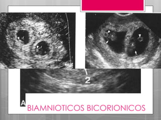 BIAMNIOTICOS BICORIONICOS
 