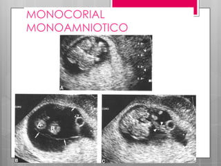 MONOCORIAL
MONOAMNIOTICO
 