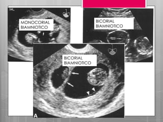 BICORIAL
BIAMNIOTICO
MONOCORIAL
BIAMNIOTICO
BICORIAL
BIAMNIOTICO
 