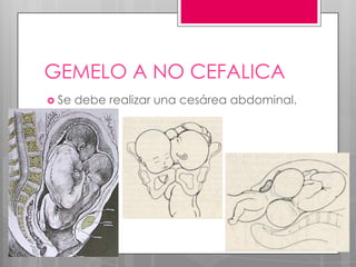 GEMELO A NO CEFALICA
 Se debe realizar una cesárea abdominal.
 