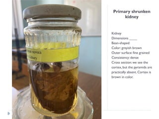 Primary shrunken
kidney
Kidney
Dimensions ____
Bean-shaped
Color: greyish brown
Outer surface: fine grained
Consistency: dense
Cross section: we see the
cortex, but the pyramids are
practically absent. Cortex is
brown in color.
 