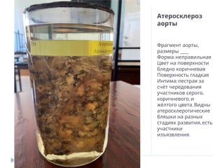 Атеросклероз
аорты
,
Фрагмент аорты
___
размеры
:
Форма неправильная
Цвет на поверхности
бледно коричневая
Поверхность гладкая
:
Интима пестрая за
счёт чередования
,
участников серого
,
коричневого и
.
жёлтого цвета Видны
атеросклеротические
бляшки на разных
,
стадиях развития есть
участники
.
изъязвления
 
