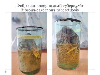 Фиброзно-кавернозный туберкулёз
Fibrous-cavernous tuberculosis
 