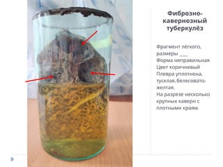 -
Фиброзно
кавернозный
туберкулёз
,
Фрагмент лёгкого
___
размеры
Форма неправильная
Цвет коричневый
,
Плевра уплотнена
, -
тусклая белесовато
.
желтая
На разрезе несколько
крупных каверн с
.
плотными краям
 