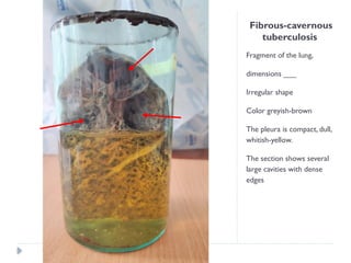 Fibrous-cavernous
tuberculosis
Fragment of the lung,
dimensions ___
Irregular shape
Color greyish-brown
The pleura is compact, dull,
whitish-yellow.
The section shows several
large cavities with dense
edges
 