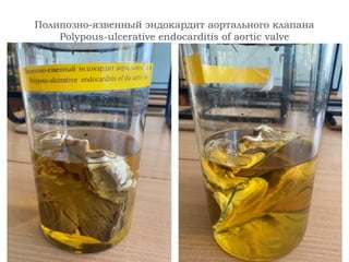 Полипозно-язвенный эндокардит аортального клапана
Polypous-ulcerative endocarditis of aortic valve
 