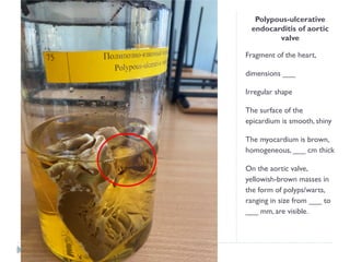 Polypous-ulcerative
endocarditis of aortic
valve
Fragment of the heart,
dimensions ___
Irregular shape
The surface of the
epicardium is smooth, shiny
The myocardium is brown,
homogeneous, ___ cm thick
On the aortic valve,
yellowish-brown masses in
the form of polyps/warts,
ranging in size from ___ to
___ mm, are visible.
 