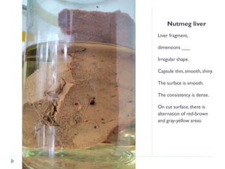 Nutmeg liver
Liver fragment,
dimensions ___
Irregular shape.
Capsule thin, smooth, shiny.
The surface is smooth.
The consistency is dense.
On cut surface, there is
alternation of red-brown
and gray-yellow areas.
 