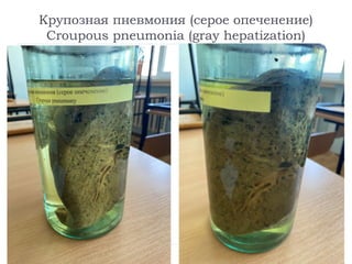 Крупозная пневмония (серое опеченение)
Croupous pneumonia (gray hepatization)
 