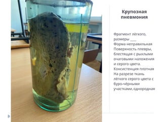 Крупозная
пневмония
,
Фрагмент лёгкого
___
размеры
Форма неправильная
,
Поверхность плевры
блестящая с рыхлыми
очаговыми наложения
.
и серого цвета
Консистенция плотная
На разрезе ткань
лёгкого серого цвета с
-
буро чёрными
,
участками однородная
 