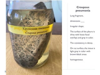Croupous
pneumonia
Lung fragment,
dimensions ___
Irregular shape.
The surface of the pleura is
shiny with loose focal
overlays and gray in color.
The consistency is dense.
On cut surface, the tissue is
light gray in color with
brown-black areas
homogeneous
 