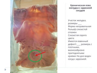Хроническая язва
желудка с аррозией
сосудов
,
Участок желудка
___
размеры
Форма неправильная
Рельеф слизистой
сглажен
Слизистая серого
цвета
Имеется язвенный
дефект?, ___ ,
размера с
,
плотными
валикообразно
приподнятыми
.
краями На дне виден
.
сосуд с аррозией
 