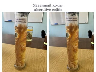 Язвенный колит
ulcerative colitis
 