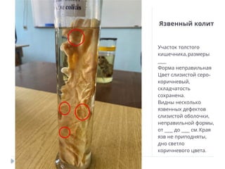 Язвенный колит
Участок толстого
,
кишечника размеры
___
Форма неправильная
-
Цвет слизистой серо
,
коричневый
складчатость
.
сохранена
Видны несколько
язвенных дефектов
,
слизистой оболочки
,
неправильной формы
___ ___ .
от до см Края
,
язв не приподняты
дно светло
.
коричневого цвета
 