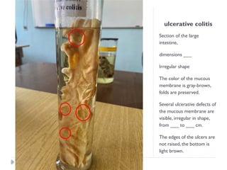 ulcerative colitis
Section of the large
intestine,
dimensions ___
Irregular shape
The color of the mucous
membrane is gray-brown,
folds are preserved.
Several ulcerative defects of
the mucous membrane are
visible, irregular in shape,
from ___ to ___ cm.
The edges of the ulcers are
not raised, the bottom is
light brown.
 