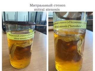 Митральный стеноз
mitral stenosis
 