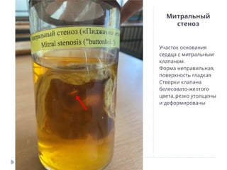 Митральный
стеноз
Участок основания
сердца с митральным
.
клапаном
,
Форма неправильная
поверхность гладкая
Створки клапана
-
белесовато желтого
,
цвета резко утолщены
и деформированы
 