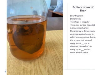 Echinococcus of
liver
Liver fragment
Dimensions ___
The shape is irregular
The outer surface (capsule)
is thin, smooth, shiny
Consistency is dense-elastic
on cross section brown in
color, heterogeneous due to
the presence of a round
cavity about __ cm in
diameter, the wall of the
cavity up to __ cm is a
dense whitish tissue.
 