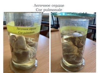 Легочное сердце
Cor pulmonale
 