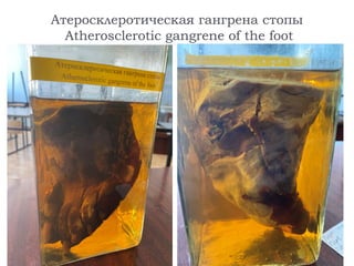 Атеросклеротическая гангрена стопы
Atherosclerotic gangrene of the foot
 