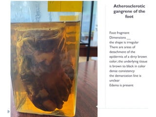 Atherosclerotic
gangrene of the
foot
Foot fragment
Dimensions __
the shape is irregular
There are areas of
detachment of the
epidermis of a dirty brown
color; the underlying tissue
is brown to black in color
dense consistency
the demarcation line is
unclear
Edema is present
 