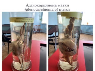 Аденокарцинома матки
Adenocarcinoma of uterus
 