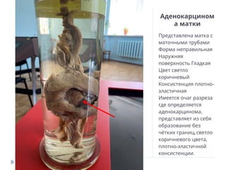 Аденокарцином
а матки
Представлена матка с
маточными трубами
Форма неправильная
Наружняя
поверхность Гладкая
Цвет светло
коричневый
-
Консистенция плотно
эластичная
Имеется очаг разреза
где определяется
,
аденокарцинома
представляет из себя
образование без
,
чётких границ светло
,
коричневого цвета
-
плотно эластичной
.
консистенции
 