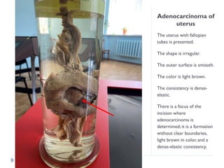 Adenocarcinoma of
uterus
The uterus with fallopian
tubes is presented.
The shape is irregular.
The outer surface is smooth.
The color is light brown.
The consistency is dense-
elastic.
There is a focus of the
incision where
adenocarcinoma is
determined; it is a formation
without clear boundaries,
light brown in color, and a
dense-elastic consistency.
 