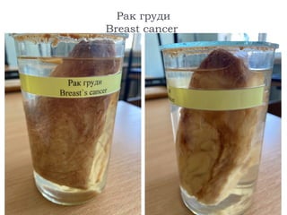 Рак груди
Breast cancer
 