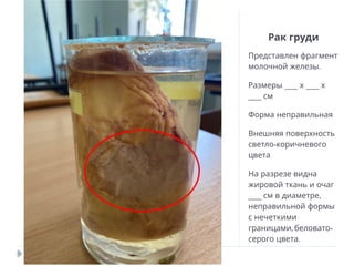 Рак груди
Представлен фрагмент
.
молочной железы
___ ___
Размеры х х
___ см
Форма неправильная
Внешняя поверхность
-
светло коричневого
цвета
На разрезе видна
жировой ткань и очаг
___ ,
см в диаметре
неправильной формы
с нечеткими
, -
границами беловато
.
серого цвета
 