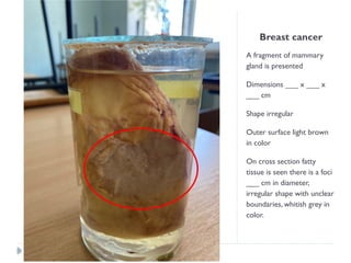 Breast cancer
A fragment of mammary
gland is presented
Dimensions ___ x ___ x
___ cm
Shape irregular
Outer surface light brown
in color
On cross section fatty
tissue is seen there is a foci
___ cm in diameter,
irregular shape with unclear
boundaries, whitish grey in
color.
 