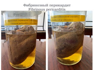 Фибринозный перикардит
Fibrinous pericarditis
 