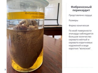 Фибринозный
перикардит
Представлено сердце
Размеры
Форма коническая
По всей поверхности
эпикарда наблюдается
большое количество
-
серовато жёлтый и
-
серовато коричневых
надожений в виде
" ".
коротких волосков
 