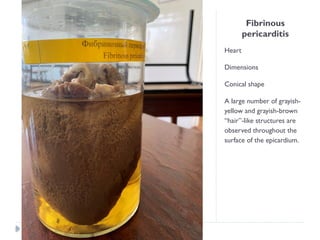 Fibrinous
pericarditis
Heart
Dimensions
Conical shape
A large number of grayish-
yellow and grayish-brown
“hair”-like structures are
observed throughout the
surface of the epicardium.
 